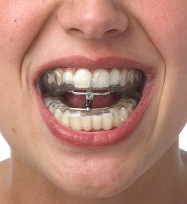 Apnea del sueño: tratamiento con férulas de avance mandibular