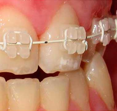 Ortodoncia estética con Brackets Cerámica