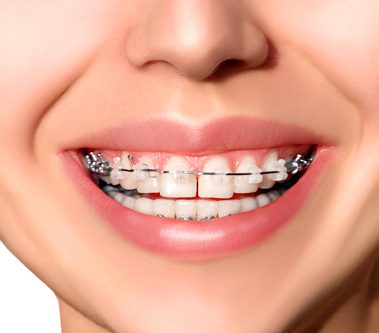 Ortodoncia estética con Brackets Cerámica