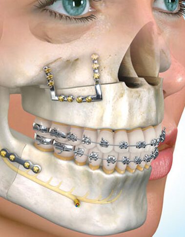 Secuencia de tratamiento de Ortodoncia