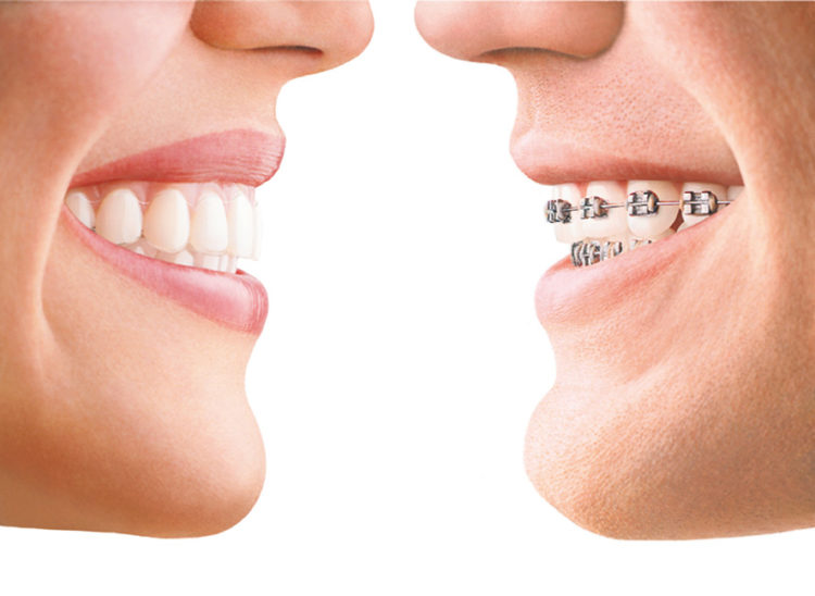 Ortodoncia con alineadores transparentes Invisalign