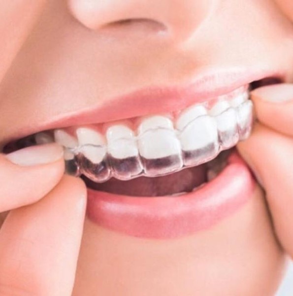 invisalign lite granada