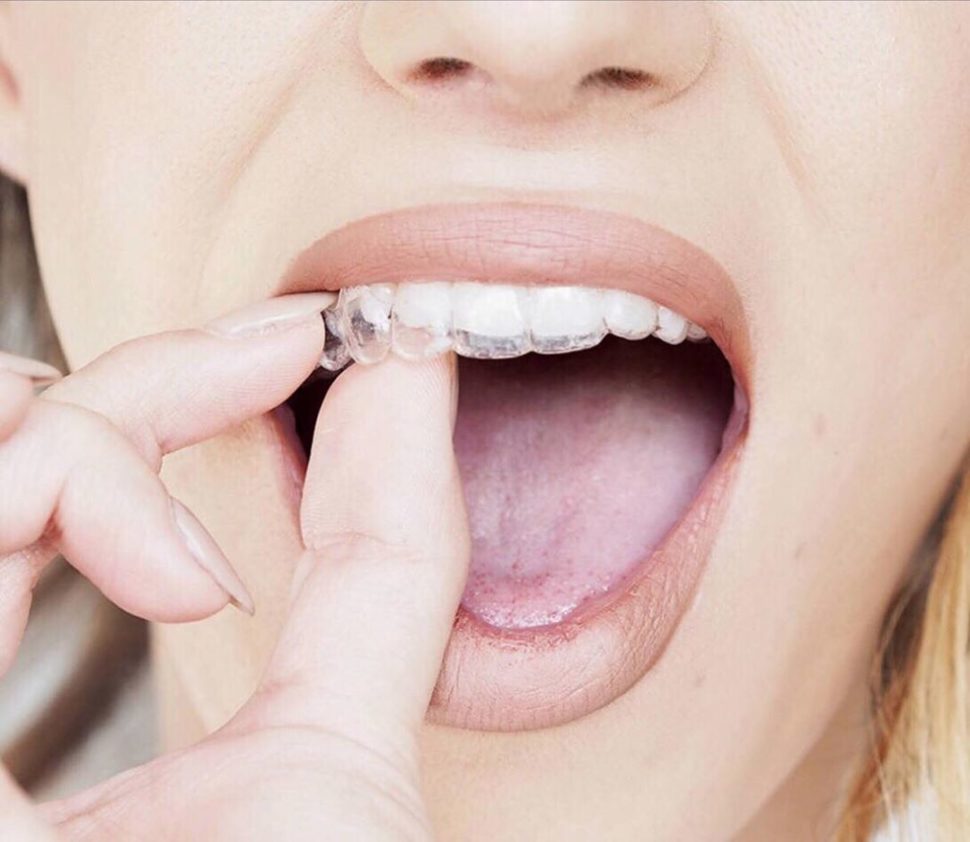 Precio ortodoncia invisalign ¿Cuánto cuesta? 【2024