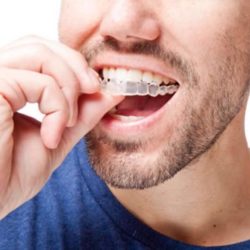 tratamiento invisalign precio 