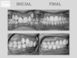 Invisalign antes y después: Clase-II mordida profunda