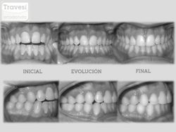 MA anterior y MC lateral con Invisalign Lite