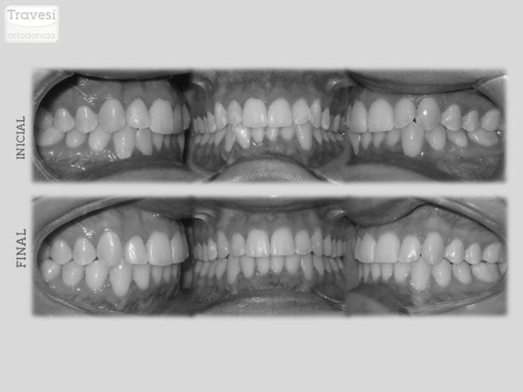 invisalign resultados en cuanto tiempo