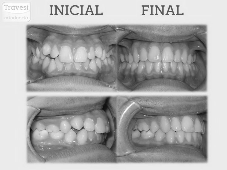 cuando se notan los resultados de invisalign