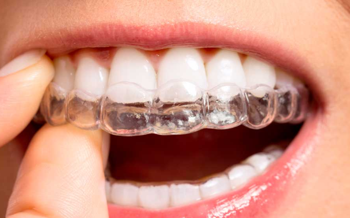 Qué es y para qué sirve la ortodoncia invisible