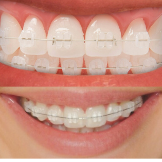 Brackets de cerámica o zafiro