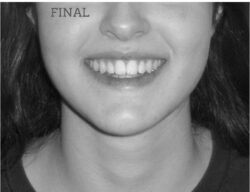 Clase III con mordida cruzada lateral Sonrisa final