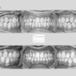 invisalign antes despues contacto borde a borde y desviacion lineas medias