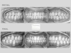 invisalign antes despues contacto borde a borde y desviacion lineas medias