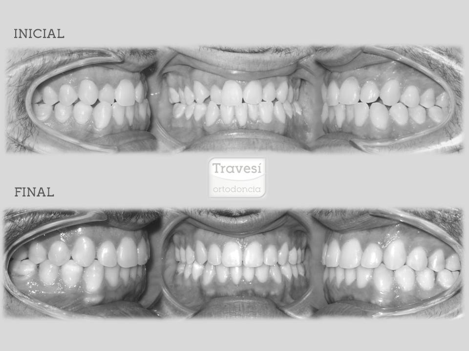 ▷ Tipos de Ortodoncia ¿Qué tratamientos existen? | Guía [2023 ]