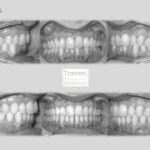 invisalign antes despues lite apinamiento