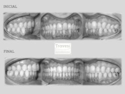 invisalign antes despues lite apinamiento