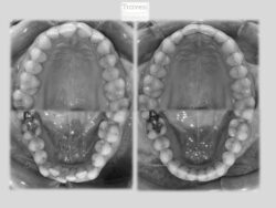 invisalign antes despues lite apinamiento oclusal