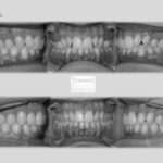 invisalign antes después lite clase ii 2a