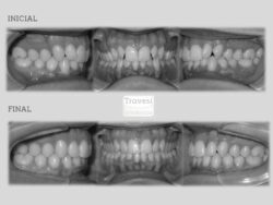 invisalign antes después lite clase ii 2a