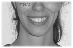 Lite Clase II 2ª Sonrisa final