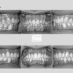 invisalign antes después lite compresión arcadas