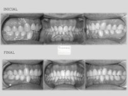 invisalign antes después lite compresión arcadas