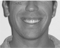 invisalign antes después lite compresión arcadas sonrisa final