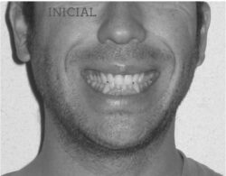 invisalign antes despues lite compresion arcadas sonrisa inicial