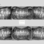 invisalign antes despues lite sobremordida