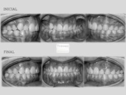 invisalign antes despues lite sobremordida