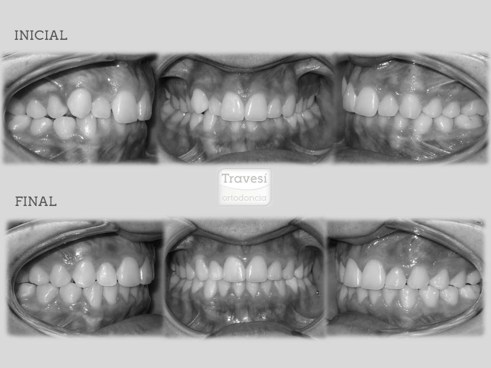 Invisalign funciona?