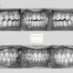 invisalign antes después retratamiento mordida abierta