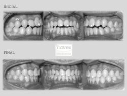 invisalign antes después retratamiento mordida abierta