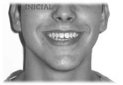 invisalign antes después retratamiento mordida abierta sonrisa inicial