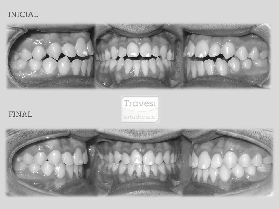 ▷ Tipos de Ortodoncia ¿Qué tratamientos existen? | Guía [2023 ]