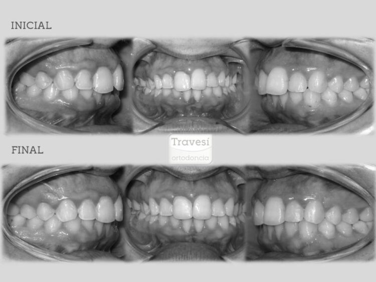 ALINEAMIENTO, NIVELACION Y CENTRADO DE LINEAS MEDIAS CON INVISALIGN I7