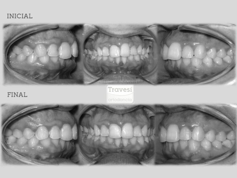 Invisalign i7 Qué es, ventajas y precio 【2024 】 Galería antes/después