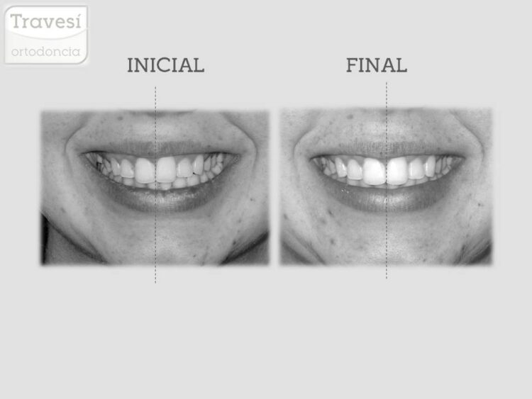 CENTRADO DE LINEAS MEDIAS EN SONRISA CON INVISALIGN I7