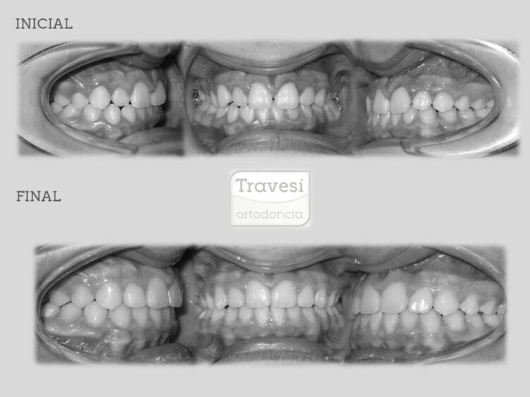 CIERRE DE DIASTEMAS CON INVISALIGN I7