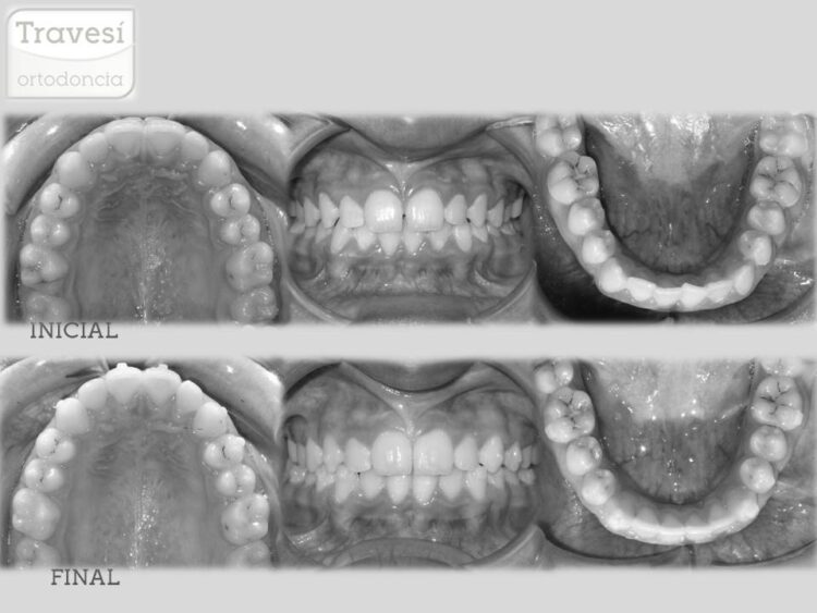 CIERRE DE DIASTEMAS Y SOLUCION DE APIÑAMIENTO CON INVISALIGN I7