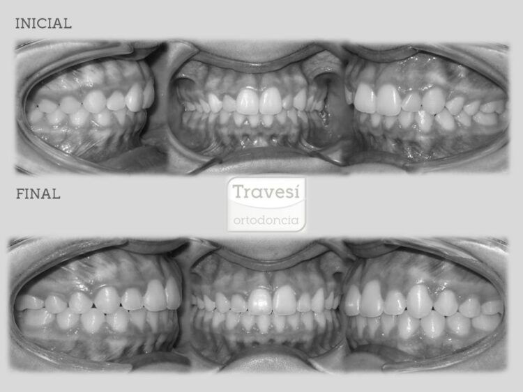 CORRECCION DE ROTACIONES CON INVISALIGN I7