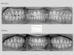 Clase III asimétrica con mordida cruzada anterior y lateral