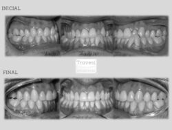 Clase-III con compresión maxilar y exodoncia de un incisivo inferior