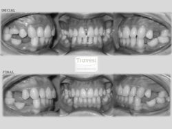 Distribución de espacios para implantes