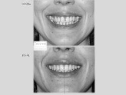 Distribución de espacios para implantes inicio y final