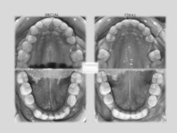 Distribución para implantes