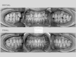 Periodontal con extracciones