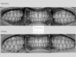 Diastema central