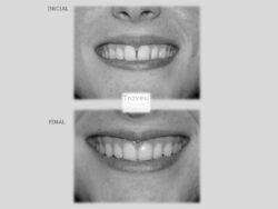 Diastema central sonrisa