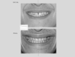 Diastemas rotaciones severas SONRISA